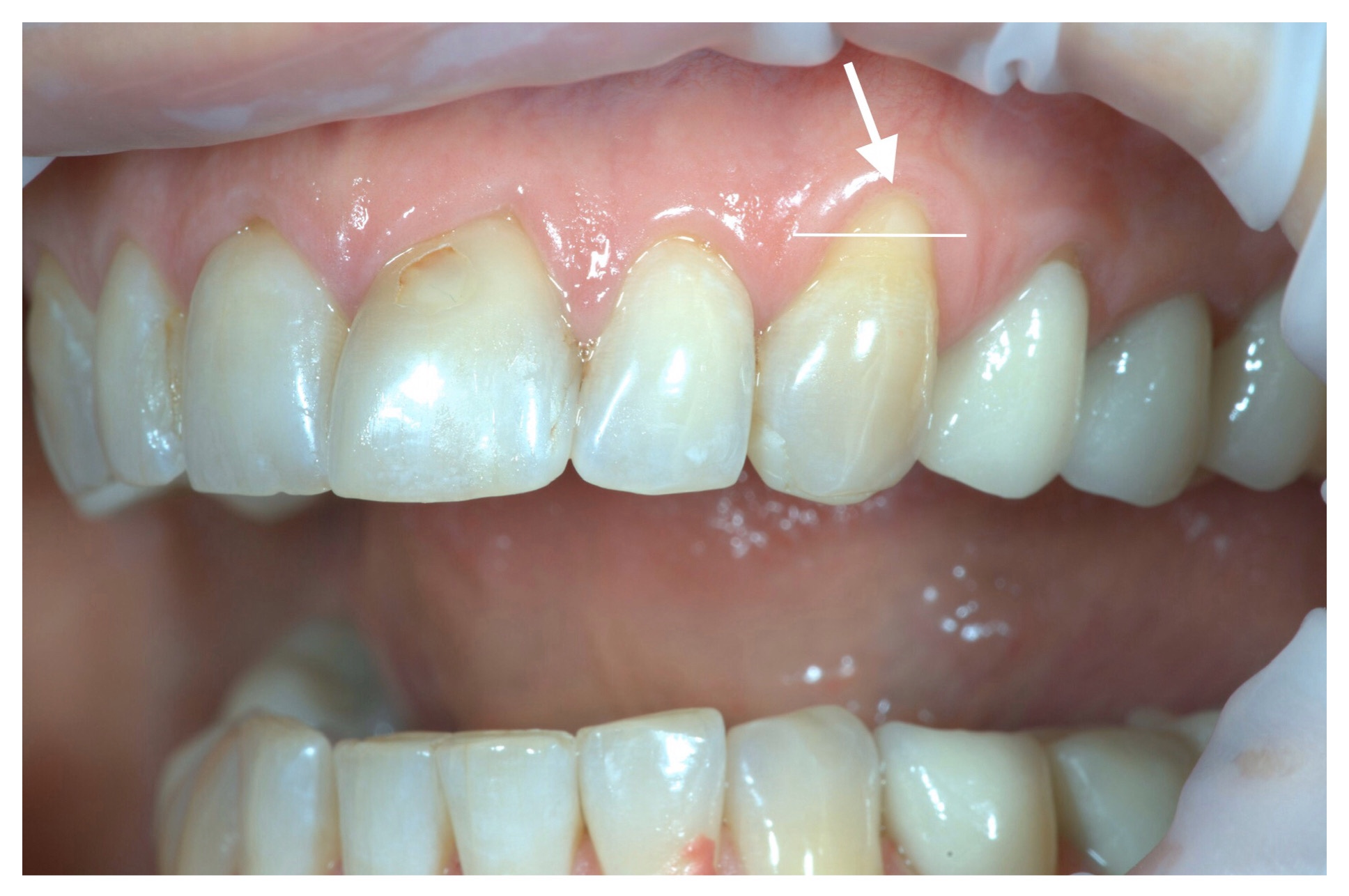 Оголились корни зубов — чем это грозит и как лечить?